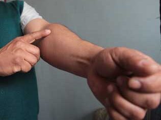 La hinchazón de un brazo puede deberse a trombosis