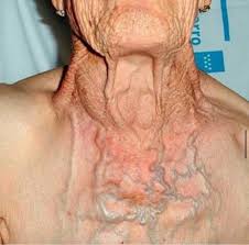 La congestión venosa de cabeza y el cuello puede deberse a un tumor