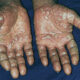 Pompholyx, dermatitis vesiculobullosa o dishidrosis
