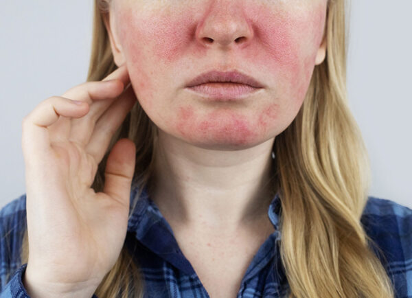 La rosácea afecta principalmente el rostro