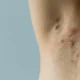 Hidradenitis supurativa