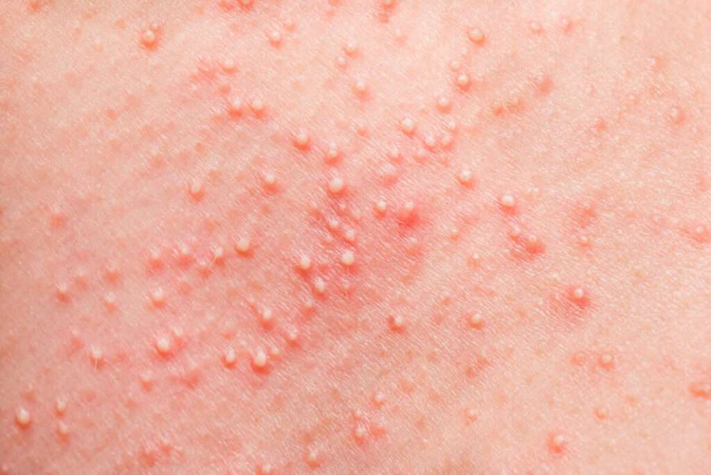 Miliaria o erupción por calor