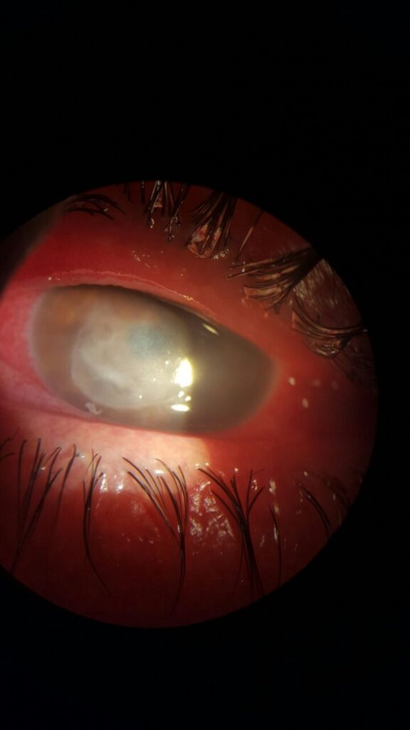 ¿Qué es la queratitis amebiana?