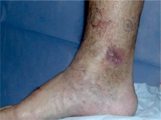 Úlceras por estasis venosa
