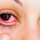 Enfermedad ocular alérgica