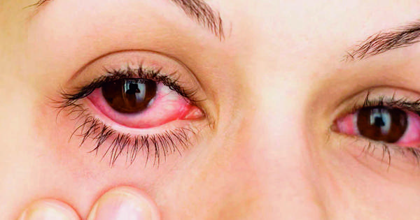 Enfermedad ocular alérgica