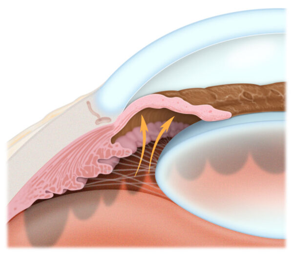 Glaucoma agudo de ángulo cerrado