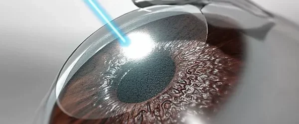 Terapia y cirugía con láser para el glaucoma crónico