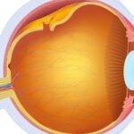 Desprendimiento de retina