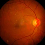 Retinocoroidopatía hipertensiva