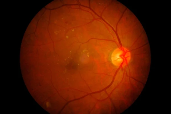 Retinocoroidopatía hipertensiva