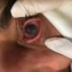 Conjuntivitis y queratitis química