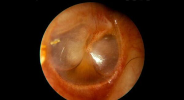 ¿Cuál es la causa de la otitis media serosa?