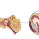 ¿Qué es la otosclerosis?