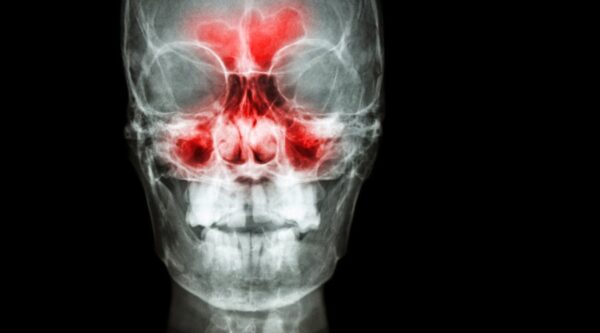 Enfermedad inflamatoria sinonasal