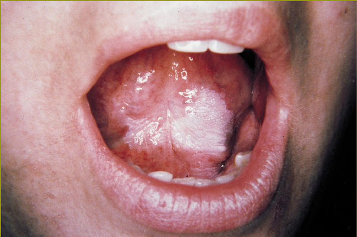 leucoplasia