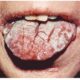 Candidiasis oral