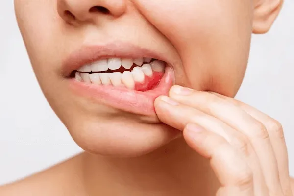 Gingivitis ulcerosa necrotizante