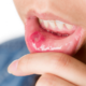 Gingivoestomatitis herpética