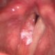 Leucoplasia de las cuerdas vocales