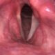 Parálisis de los pliegues vocales