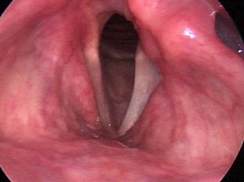 Parálisis de los pliegues vocales