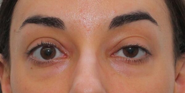 La parálisis de nervios craneales puede afectar los ojos