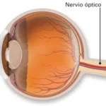 Neuritis óptica
