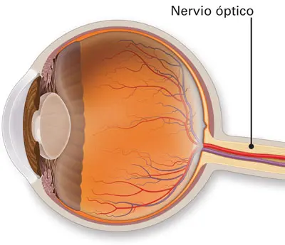 Neuritis óptica