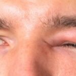 celulitis orbital