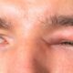celulitis orbital