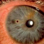 cuerpo extraño intraocular