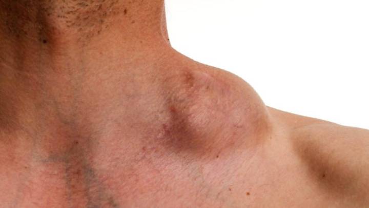 Ganglios gomosos en cuello, pueden ser linfoma