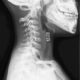 Cuerpos extraños en tráquea y bronquios