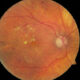 Prevención y factores de riesgo de la retinopatía diabética