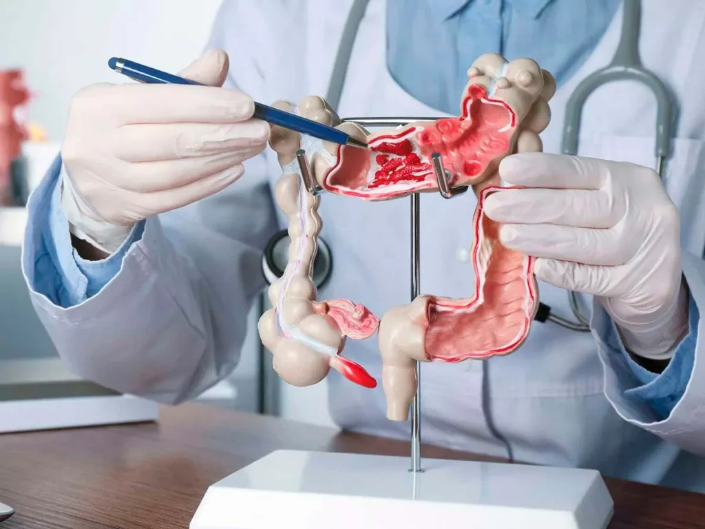 ¿Qué enfermedades se confunden con el síndrome de colon irritable?