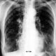 Aspergillosis Broncopulmonar Alérgica