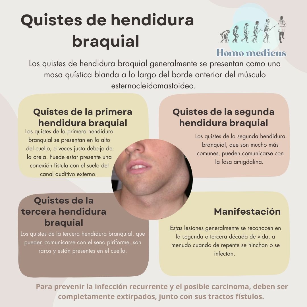 Quistes de la hendidura braquial