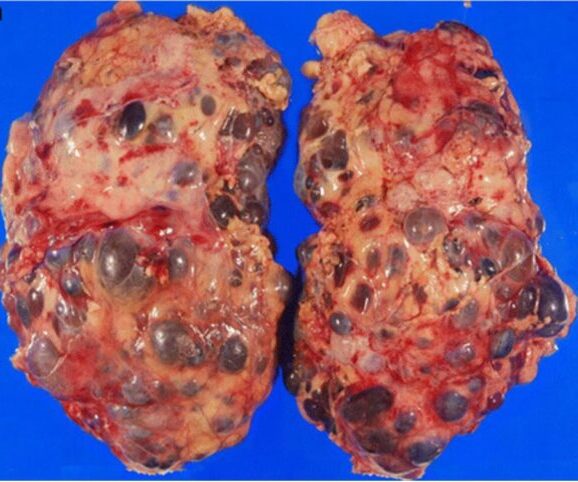 Enfermedad renal poliquística autosómica dominante