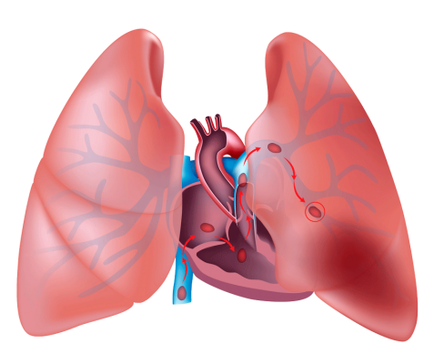 Manifestaciones del tromboembolismo venoso pulmonar