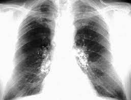 ¿Qué son las neumoconiosis?