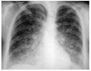 nfermedad pulmonar inducida por medicamentos