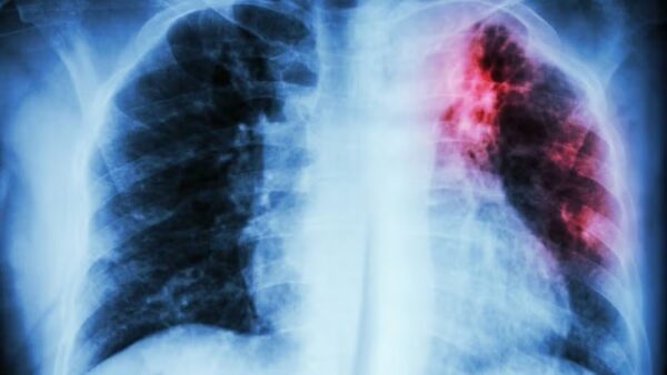 Daño pulmonar por radiación