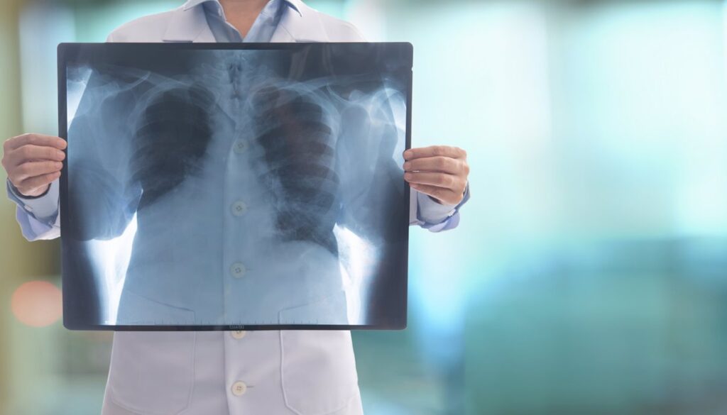 Neumonitis por radiación