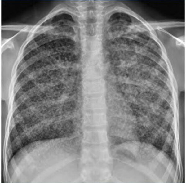 Infiltrados pulmonares en pacientes inmunocomprometidos