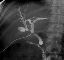 Lesiones iatrogénicas del conducto biliar, un problema complejo