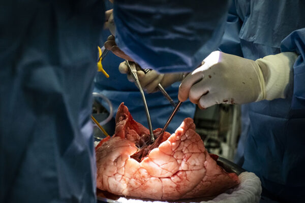 Generalidades del trasplante pulmonar