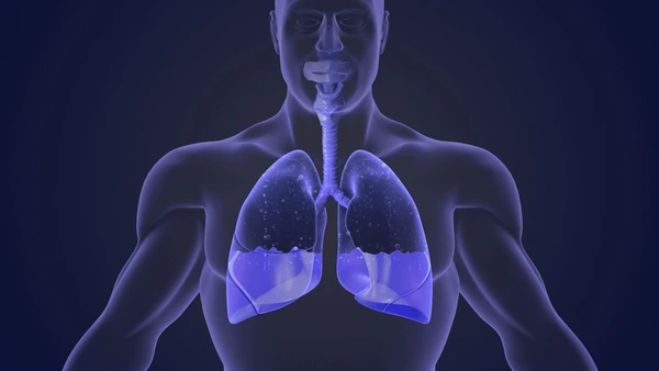 Manifestaciones de los derrames pleurales