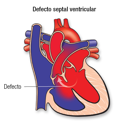 Defectos septales ventriculares