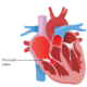 Estenosis tricuspídea